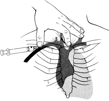 ProcGuide: Subclavian Central Line