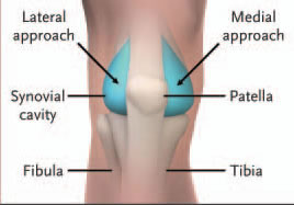 Knee Arthrocentesis Landmarks