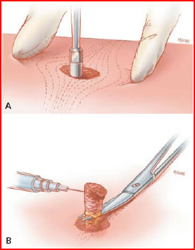 Punch Biopsy Technique